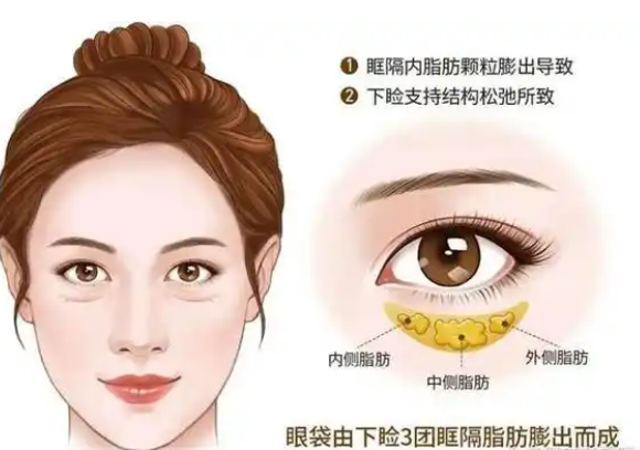 去眼袋手术
