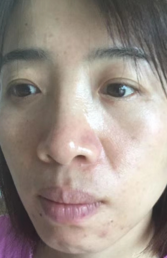 去眼袋手术