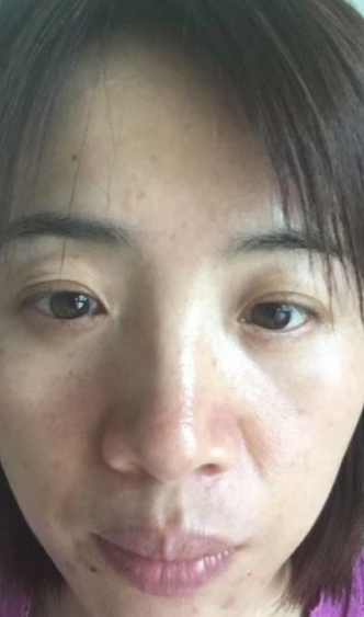 去眼袋手术