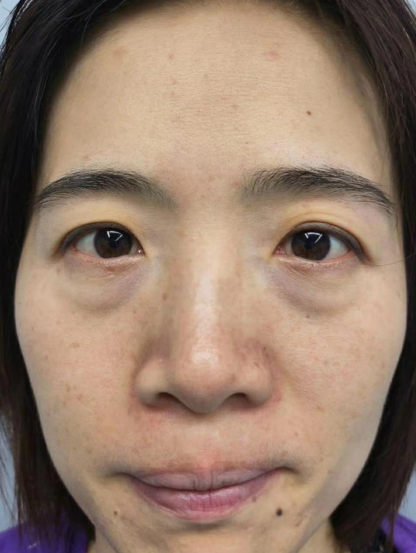 去眼袋手术