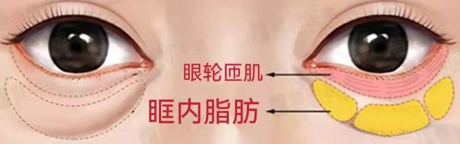 去眼袋手术