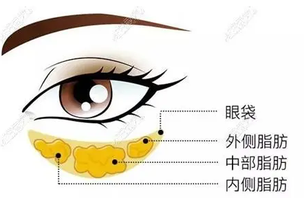 去眼袋手术