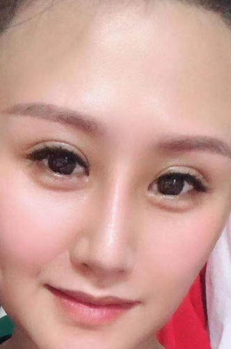 去眼袋手术