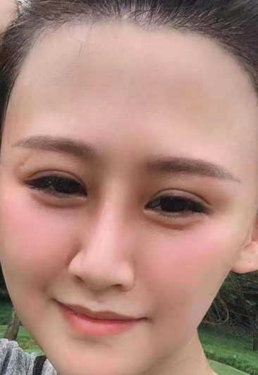 去眼袋手术