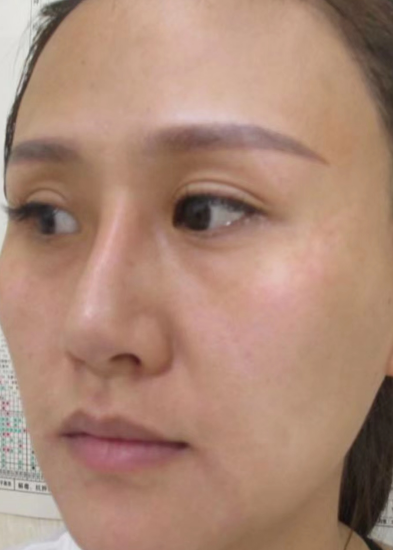 去眼袋手术