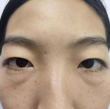 去眼袋