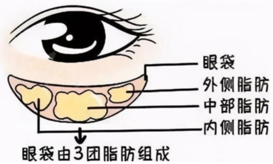 去眼袋