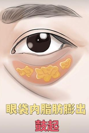 去眼袋