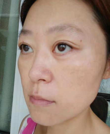 去眼袋手术