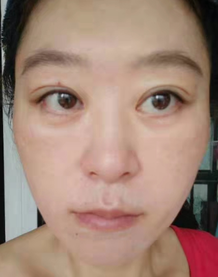 去眼袋手术