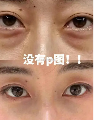 去眼袋手术