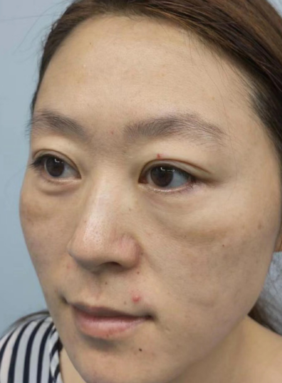 去眼袋手术