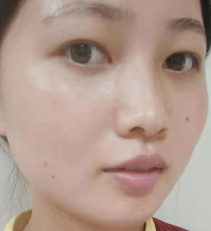 去眼袋手术