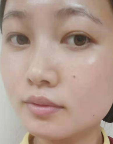 去眼袋手术