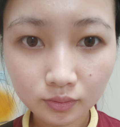 去眼袋手术
