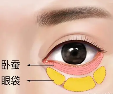 去眼袋手术