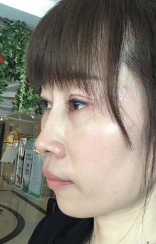 去眼袋手术