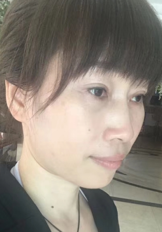 去眼袋手术