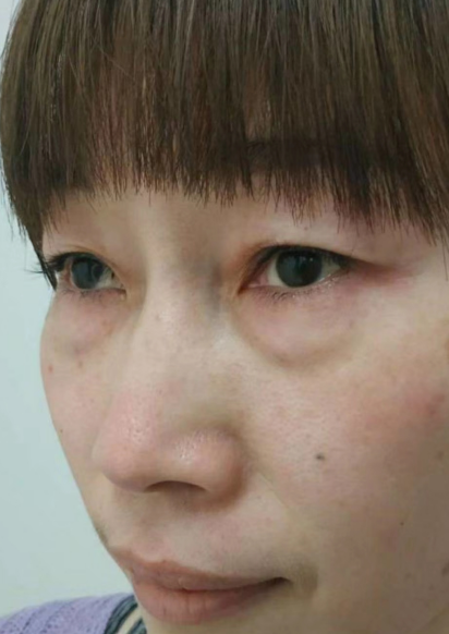 去眼袋手术