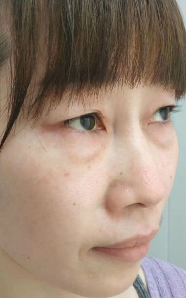 去眼袋手术