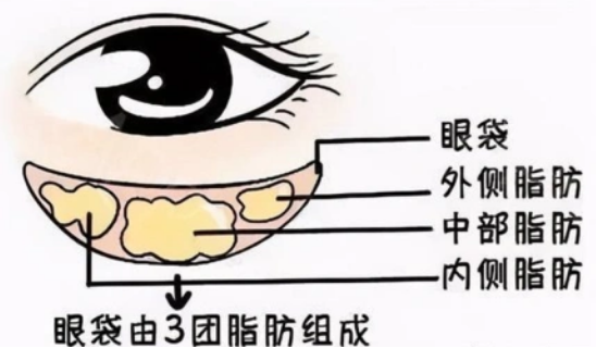 去眼袋手术