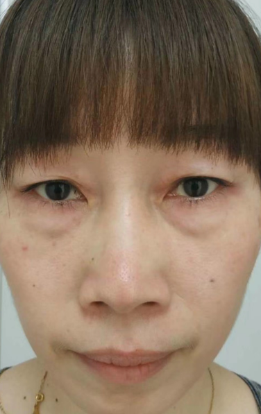 去眼袋手术