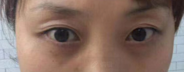 去眼袋手术