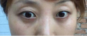 去眼袋手术