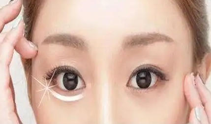 去眼袋手术