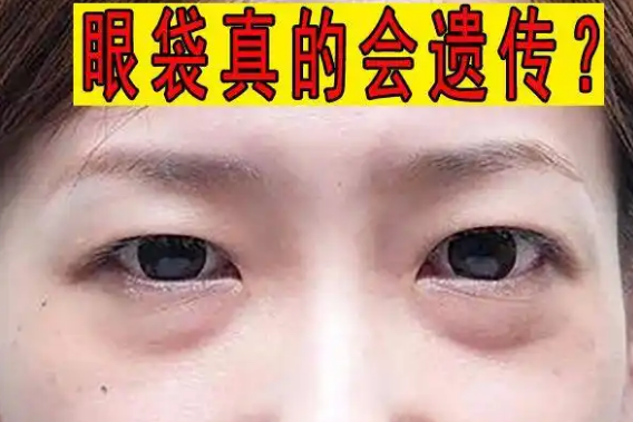 去眼袋手术