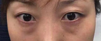 去眼袋手术