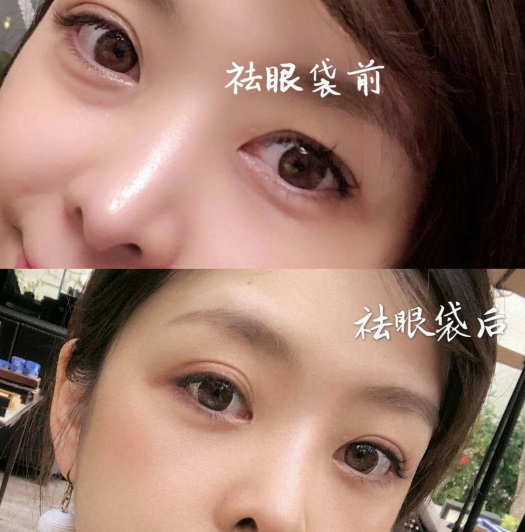 去眼袋手术