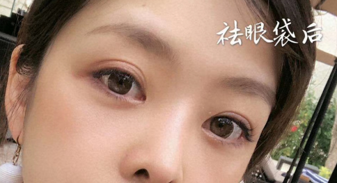 去眼袋手术