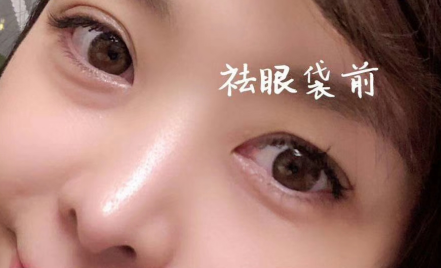 去眼袋手术