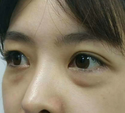 去眼袋手术