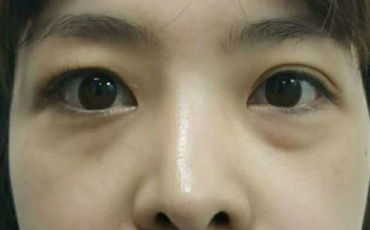 去眼袋手术