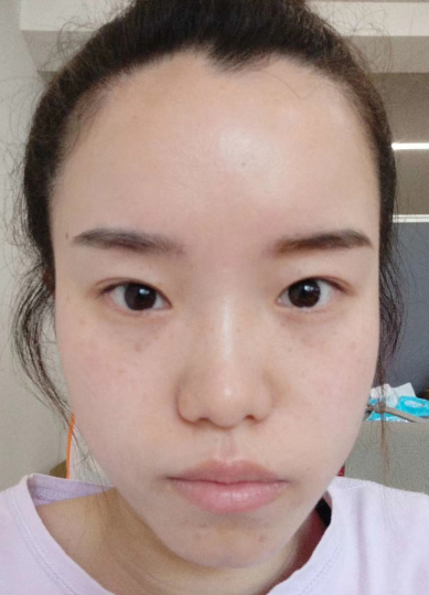 去眼袋手术