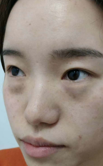 去眼袋手术