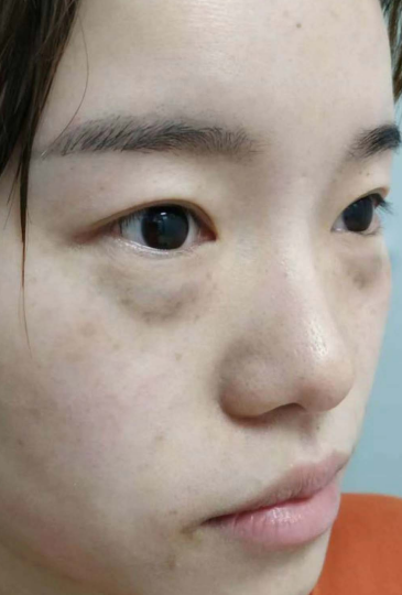 去眼袋手术
