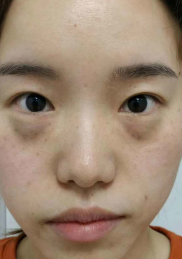 去眼袋手术