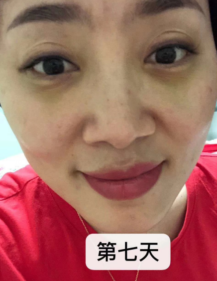 去眼袋手术