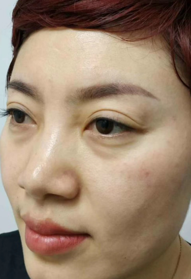 去眼袋手术