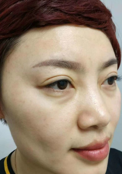 去眼袋手术