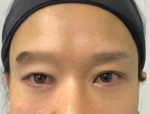 去眼袋手术