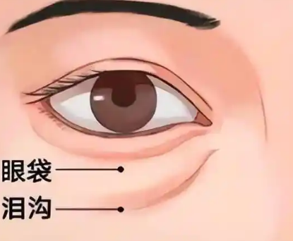 去眼袋手术