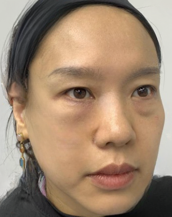 去眼袋手术