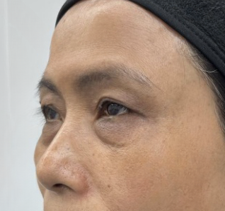 去眼袋手术