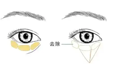 去眼袋手术