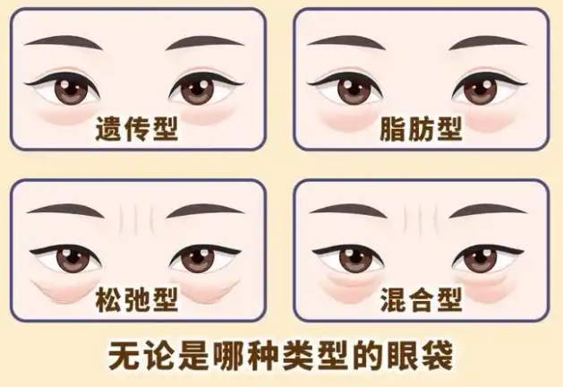 去眼袋手术