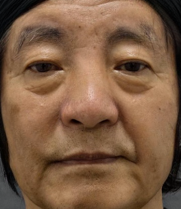 去眼袋手术